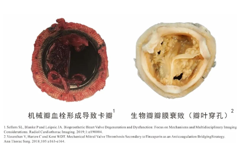 高分子瓣膜企業(yè)心銳醫(yī)療完成超千萬元天使輪融資，北極光創(chuàng)投獨家投資